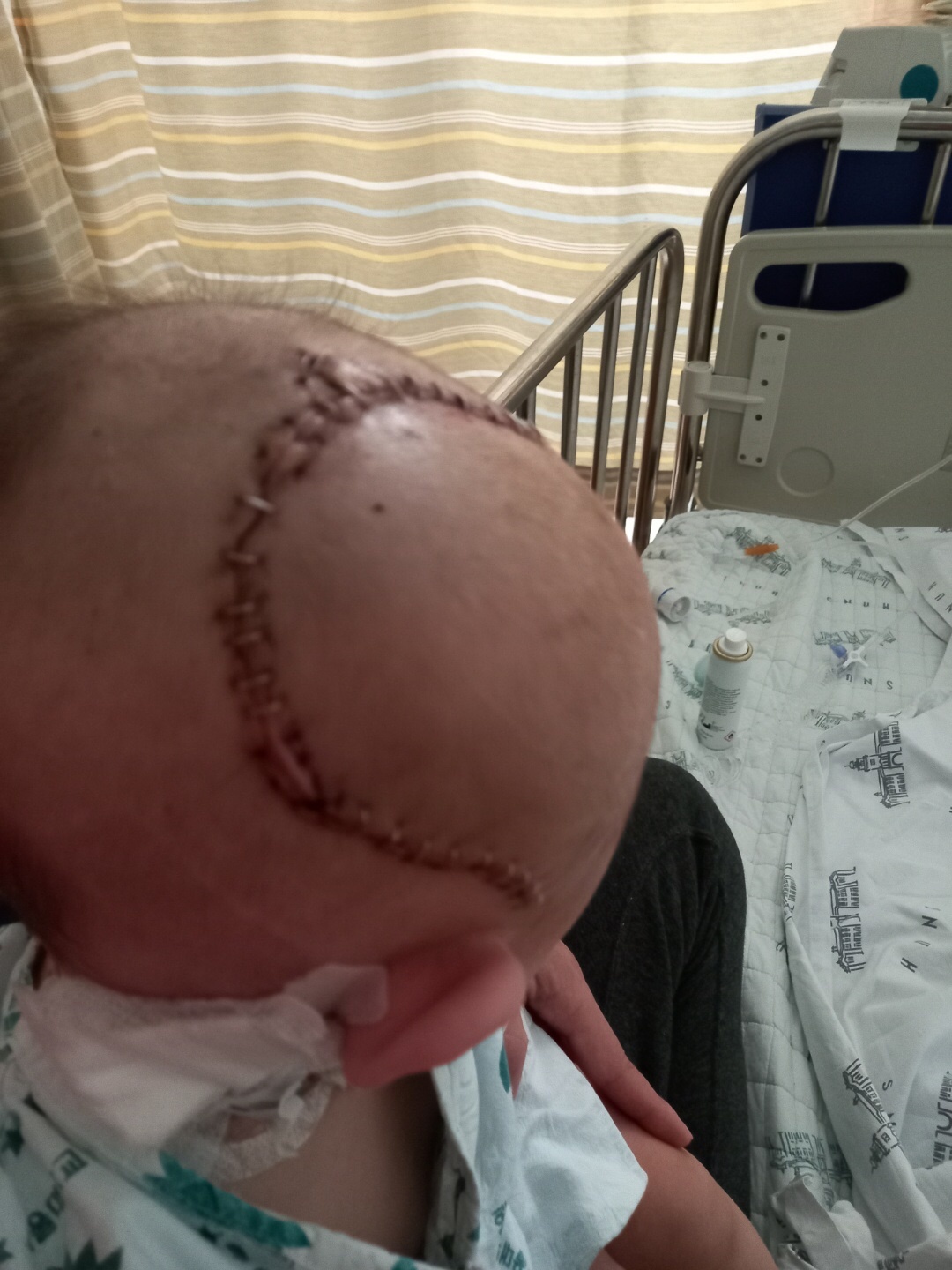 생후 9개월 때 뇌출혈 수술을 받은 정민이 모습